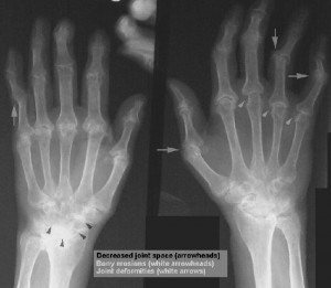 rheumatoid_arthritis